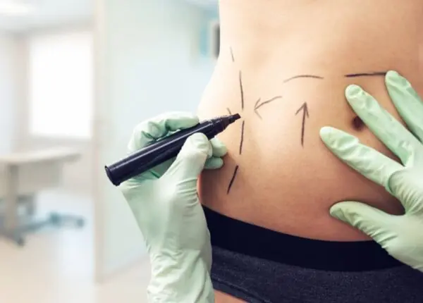 Tummy Tuck in Cancun — Mini & Full Abdominoplasty with All-Inclusive Packages