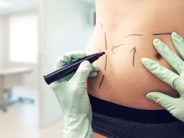 tummy tuck in cancun