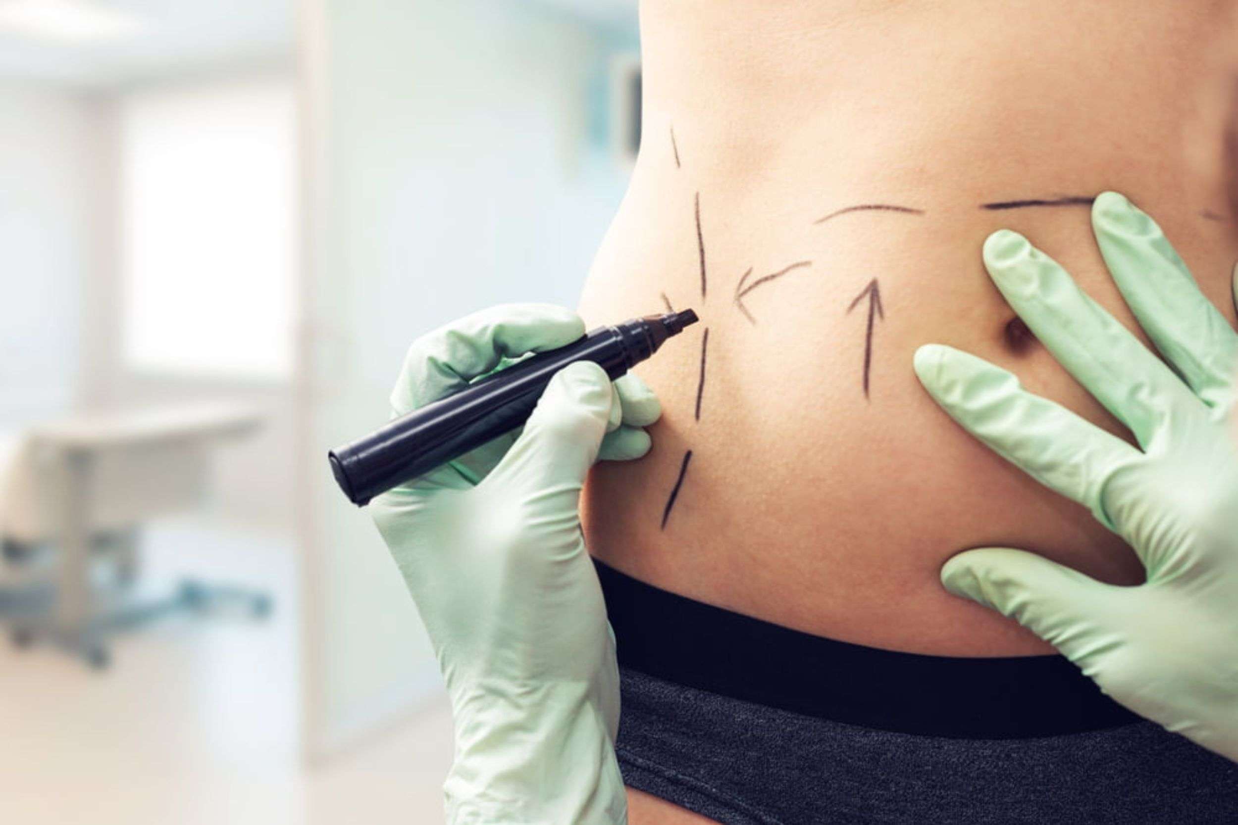 Tummy Tuck in Cancun — Mini & Full Abdominoplasty with All-Inclusive Packages