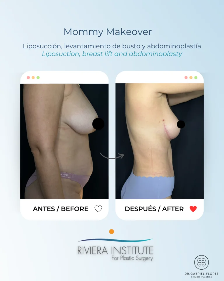 mommy makeover cancun mexico