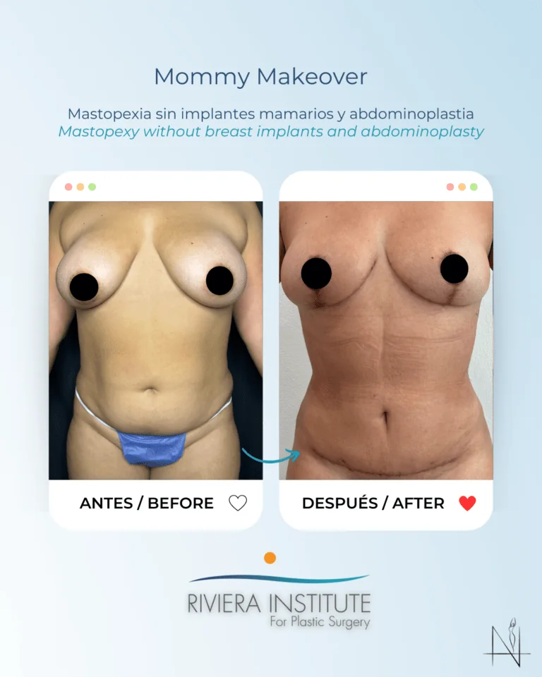 mommy makeover cancun mexico