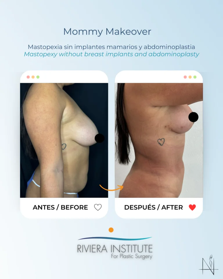 mommy makeover cancun mexico