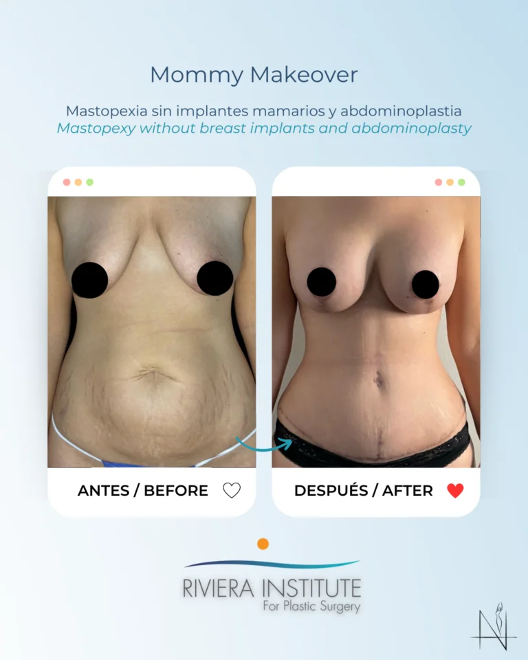 mommy makeover cancun mexico