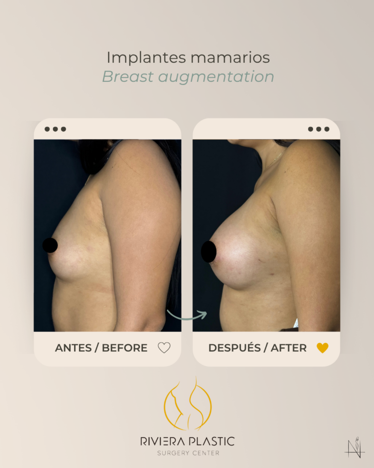 before and after mommy makeover in cancun