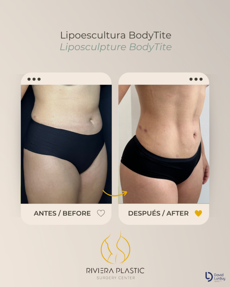 before and after lipo in cancun
