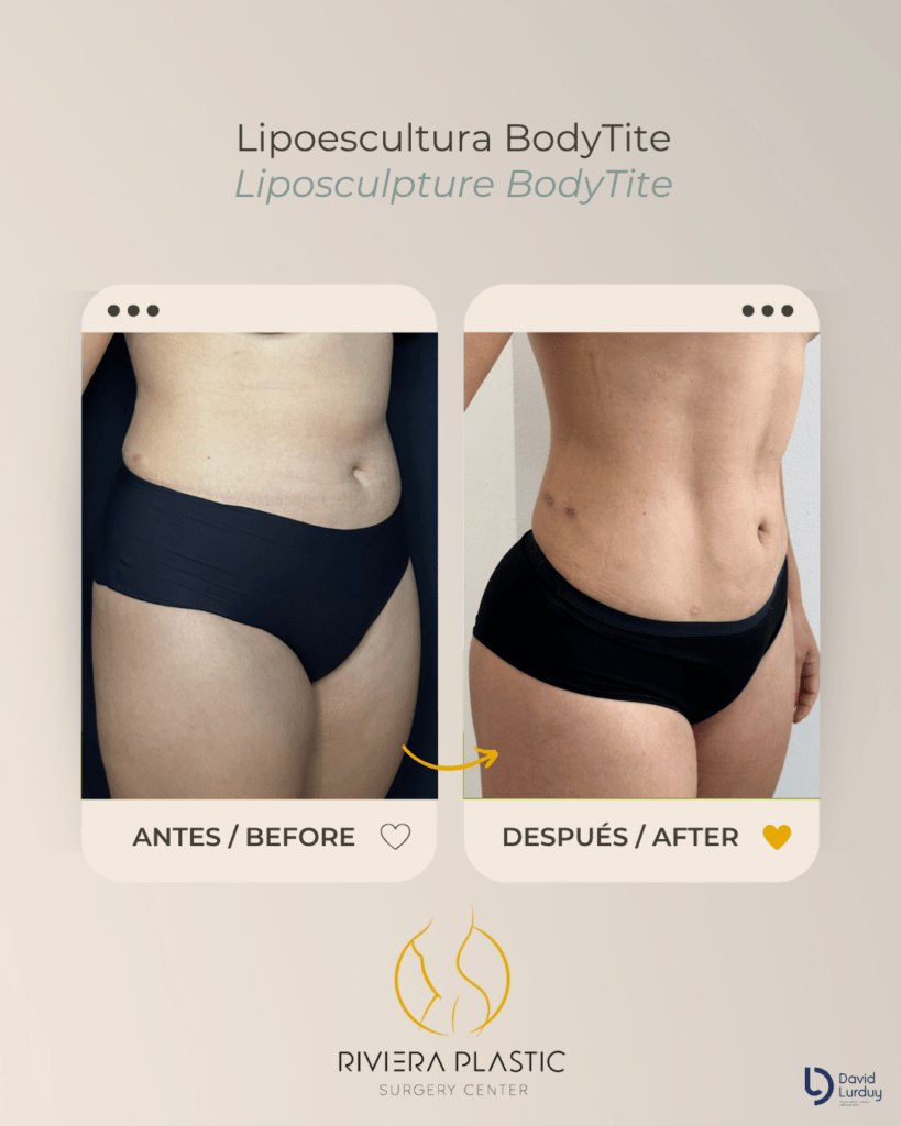 before and after lipo in cancun