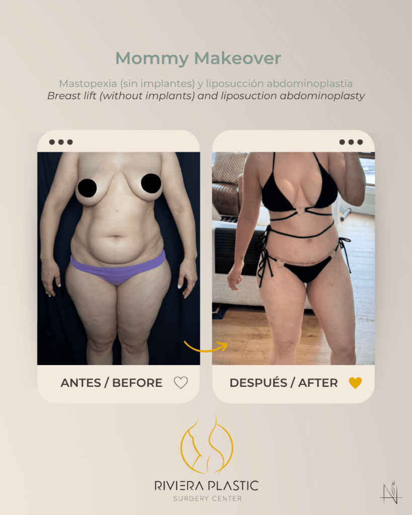 before and after mommy makeover in cancun